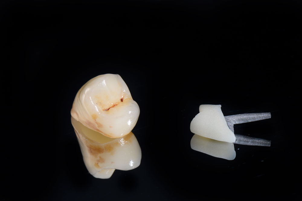 couronne céramique détails