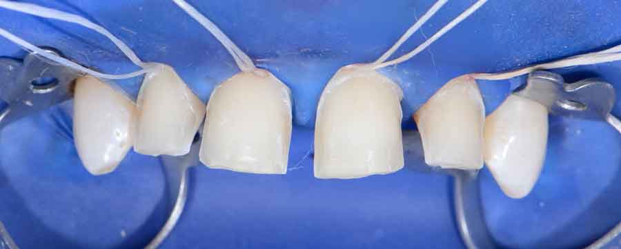 Dentiste esthétique dentaire  Blanchiment & facettes à Colomiers