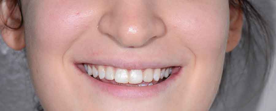 Dentiste esthétique dentaire  Blanchiment & facettes à Colomiers