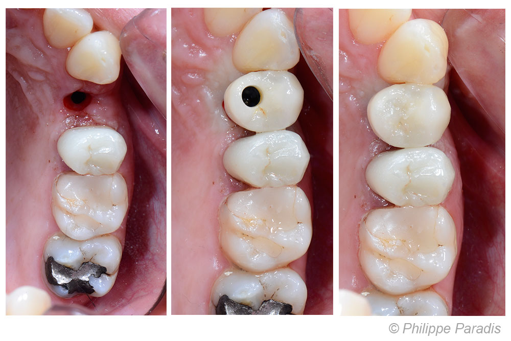 3 étapes remplacemen d'une prémolaire maxillaire par prothèse sur implant