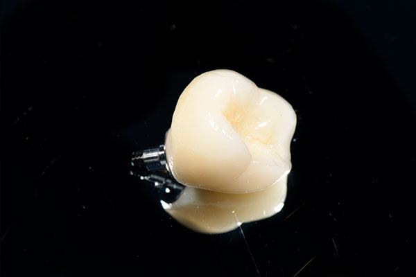 prothèse esthétique pour une mise en esthétique immédiate