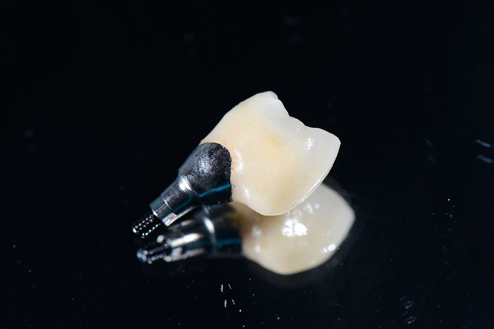 prothèse de prémollaire démontable à visser sur implant