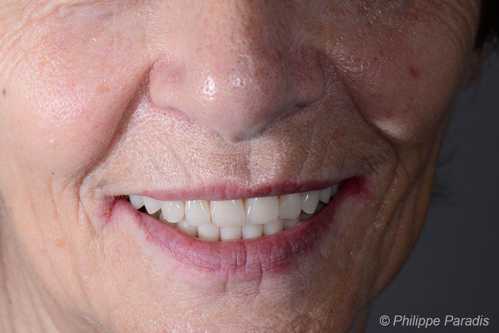 sourire après remplacement dents inférieures