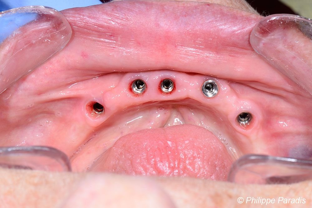 implants mandibulaires pour vissage prothèse