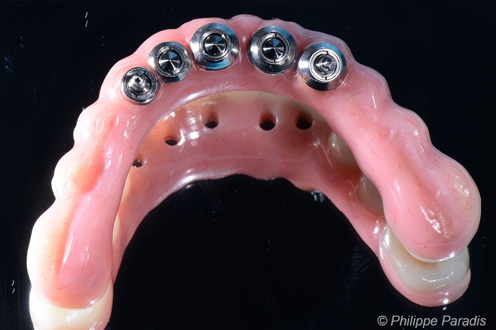 Prothèse dentaire réalisée par l'Atelier Dentaire à Toulouse et Simeda Anthogyr France