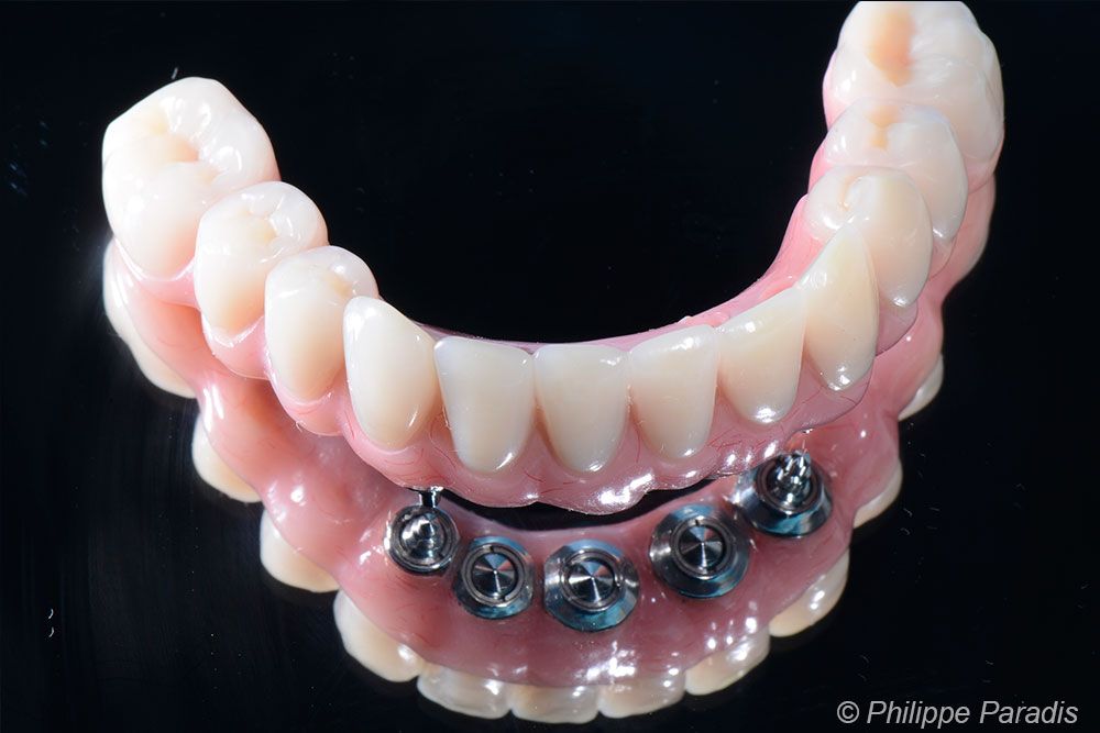 Prothèse dentaire dents inférieures vissée sur implants vue de face