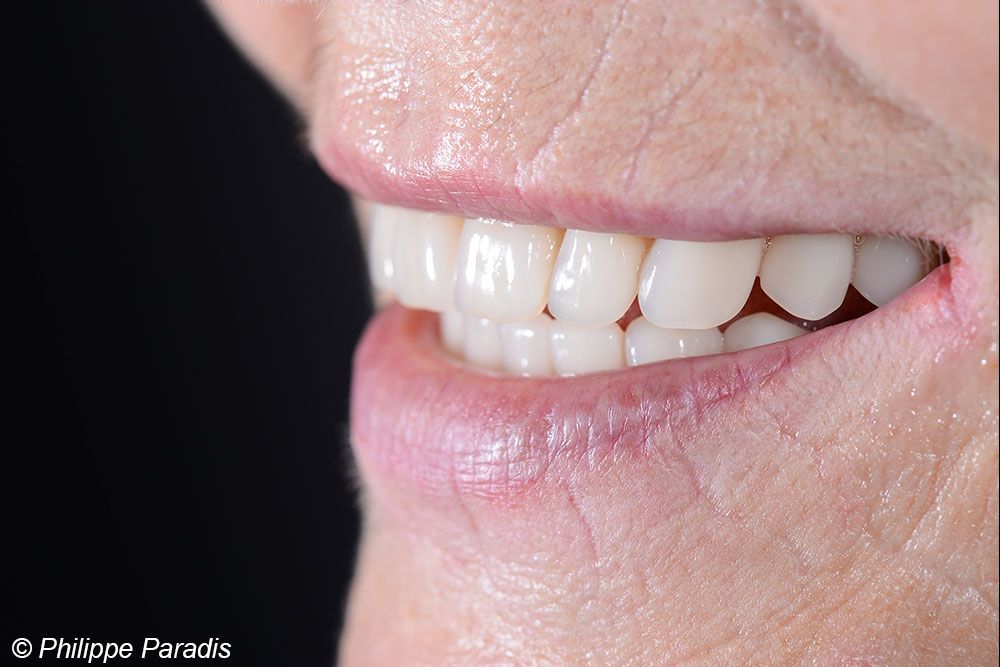 sourire phothèse remplacement dents inférieures